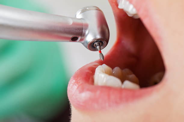 Best Emergency Root Canal Treatment in Montgomery, WV